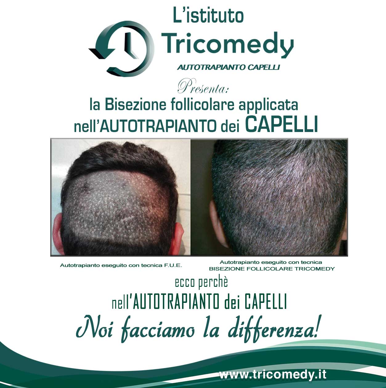 Trapianto Capelli Catania – Tricomedy centro tricologico